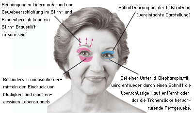 Lidkorrektur/ Lidstraffung/ Blepharoplastik