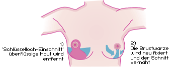 Bruststraffung/ Brustverkleinerung/ Brustkorrektur