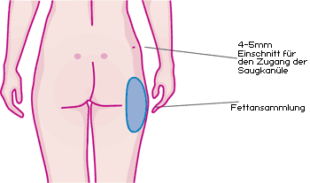 Fettabsaugung - Liposuktion - Gynäkomastie